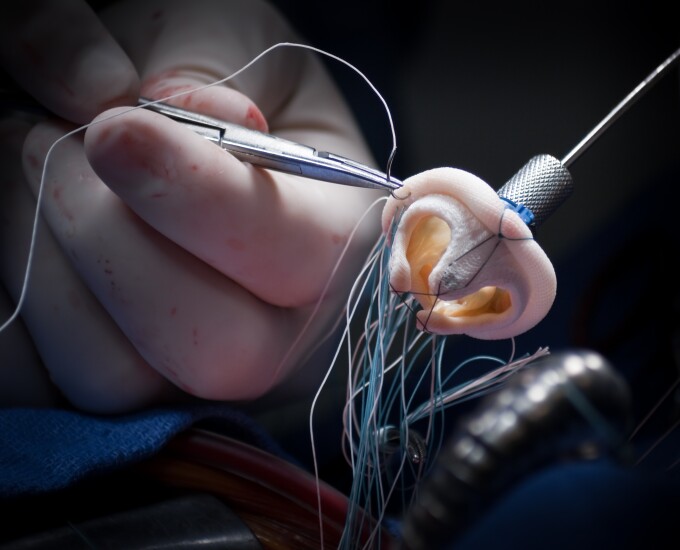 Mitral Valve Replacement Heart Surgery