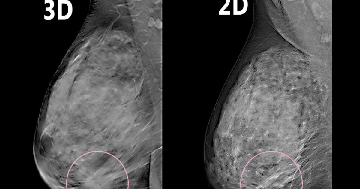 Study finds radiologists easily transition to 3D mammography Health