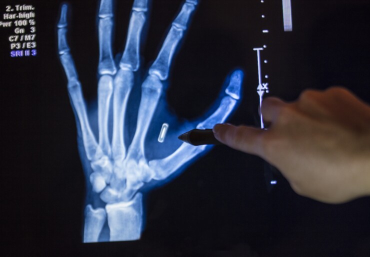 RFID implant in human hand